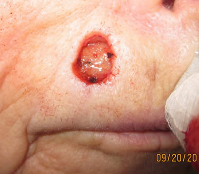 Skin cancer on lip open wound post MOHS surgery